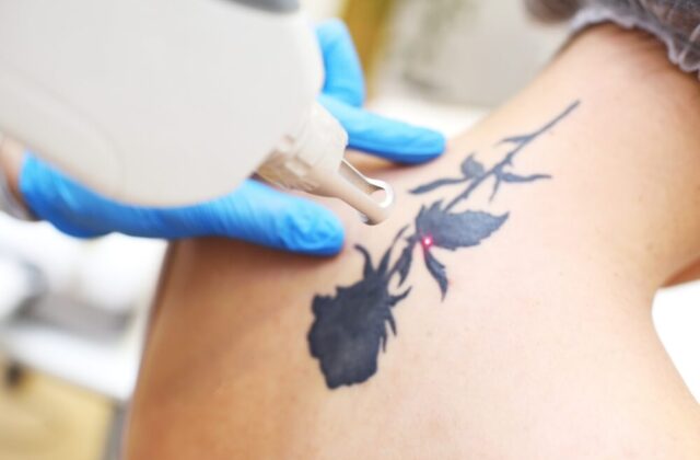 usuwanie tatuazu
